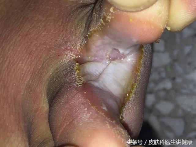 脚气引起的丹毒有什么最佳疗法,脚气感染丹毒怎么办