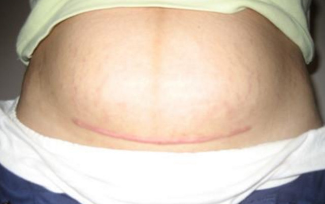 女人剖腹产两年疤痕痒痒,剖腹产刀口发痒能喝醪糟吗