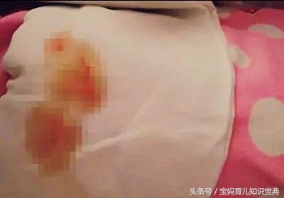 刚出生的婴儿尿布上有血迹,刚出生的女婴尿布