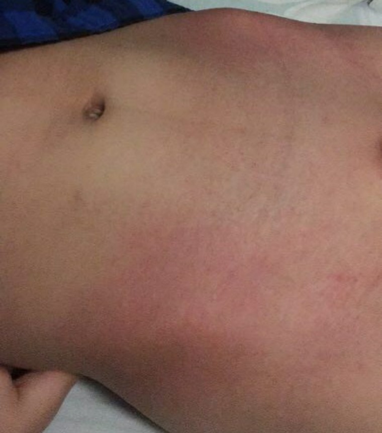 猩红热夏季,猩红热要保暖吗