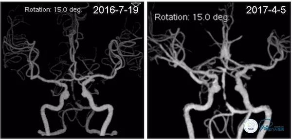 天坛医院脑血管狭窄手术做得好吗,天坛医院动脉狭窄介入手术费用