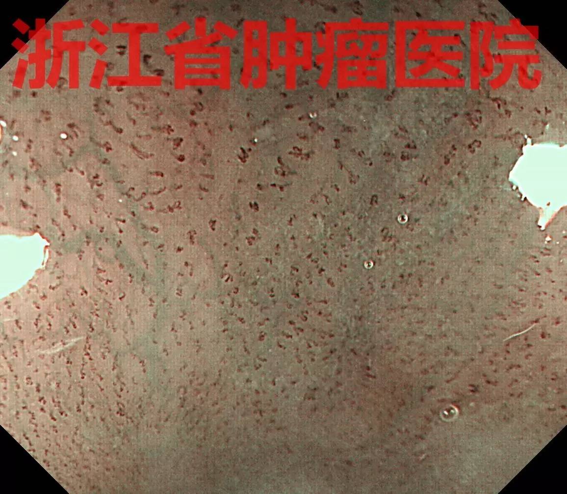 食管大面积黏膜病变,看看这家医院如何处理?!