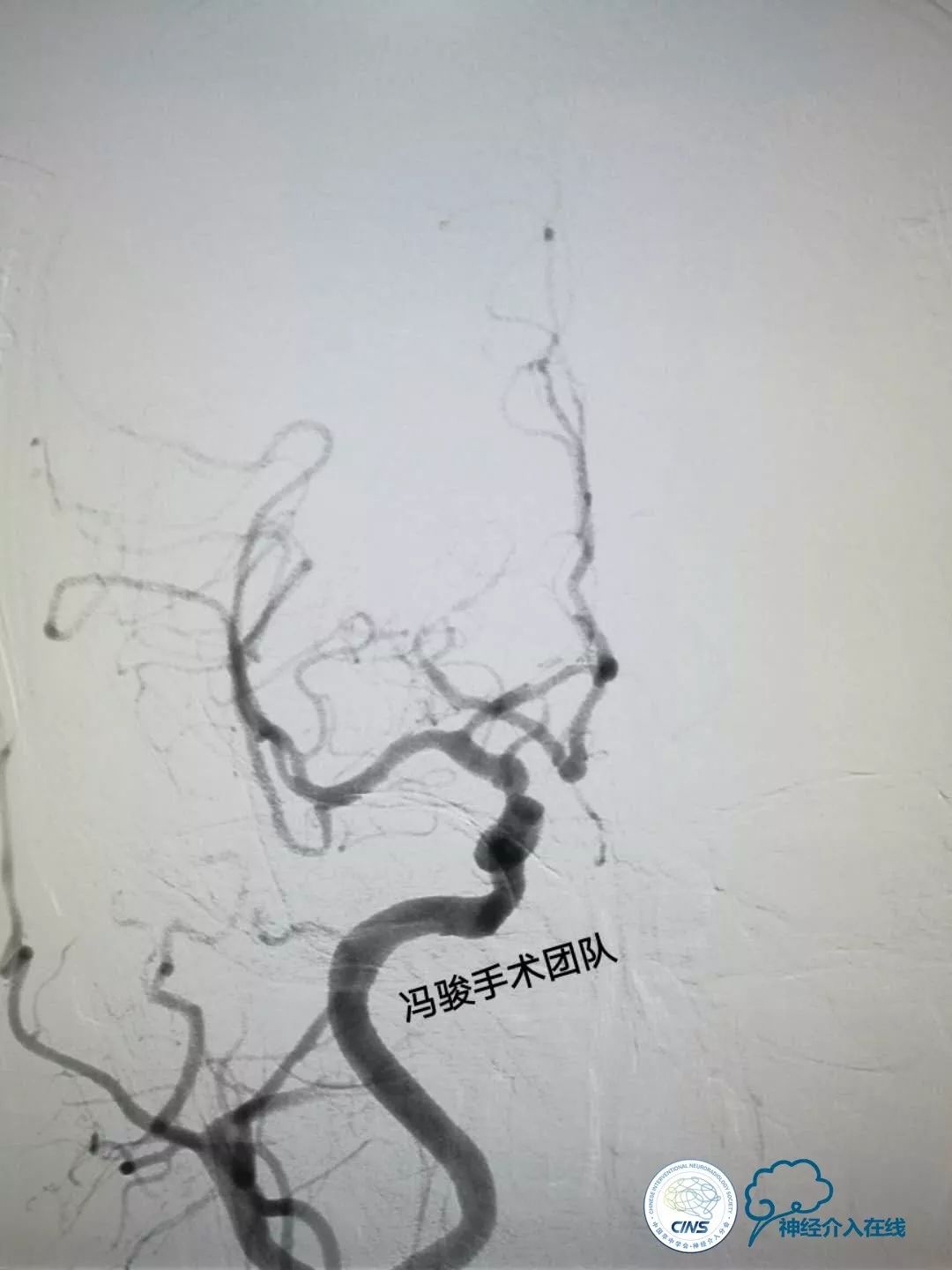 天新福—百家百言｜一例孤独椎动脉V4段并PICA重度狭窄支架手术及1年随访