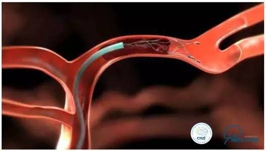 急性缺血性卒中静脉溶栓2018指南,急性缺血性卒中血管内再通标准