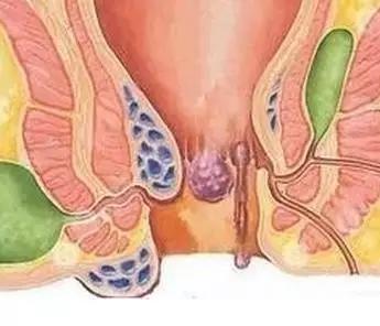 肛瘘中医诊断及鉴别,肛瘘如何诊断