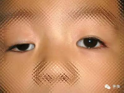 抬头纹手术会不会影响眼睛,抬头纹手术后有后遗症吗