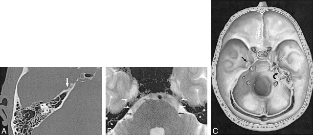 三叉神经痛和继发性的三叉神经痛,三叉神经贴治疗三叉神经痛的原理