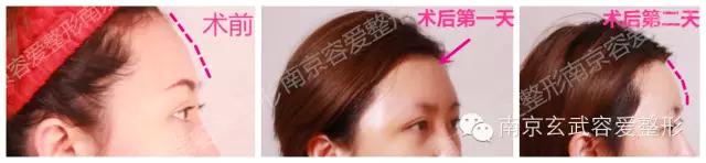 自体脂肪丰额头恢复期图,自体脂肪丰额头第一天图片