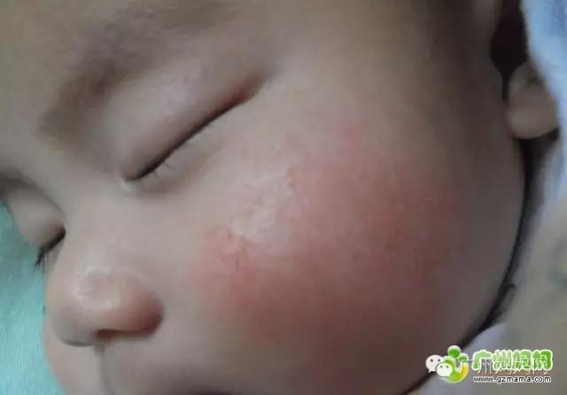 湿疹挠破皮肤感染,过敏性湿疹挠破化脓了