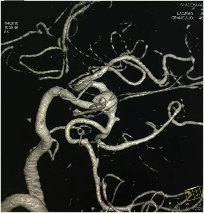 基底动脉顶端动脉瘤加左侧小脑上动脉瘤以Y型支架结合弹簧圈栓塞