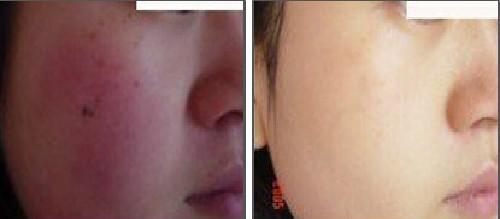 怎样改善面部红血丝肤质,脸部红血丝怎么修复医美