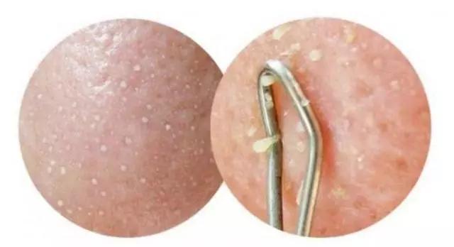 脸上能挤出白色小东西是什么,脸上鼻头挤出白色颗粒