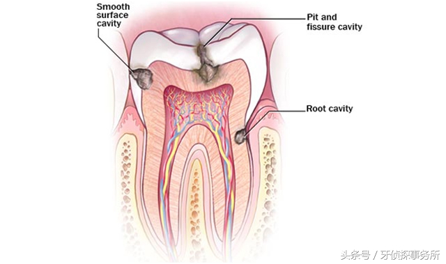 牙齿敏感抗敏牙膏有效吗,牙齿冷热酸甜都敏感用哪种牙膏
