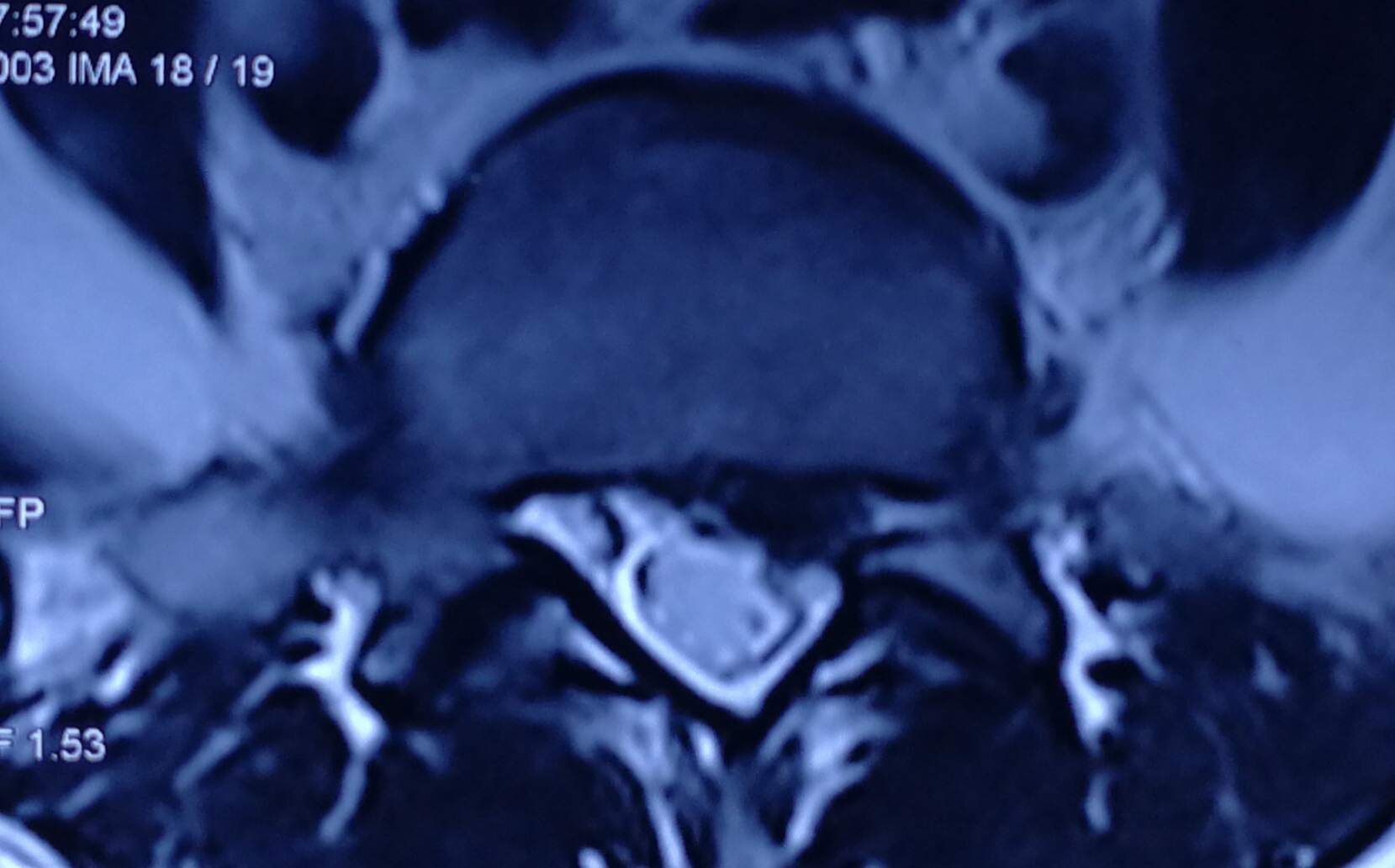 美女们的腰椎间盘突出这么多?