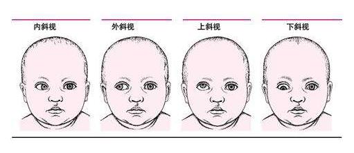 孩子斜视治疗最佳时间表,斜视最严重多少度