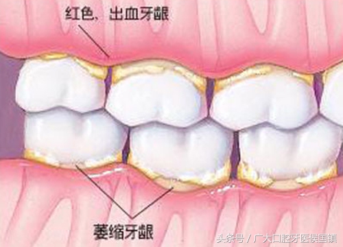 牙槽骨萎缩是什么症状,牙齿出现牙龈萎缩怎么办