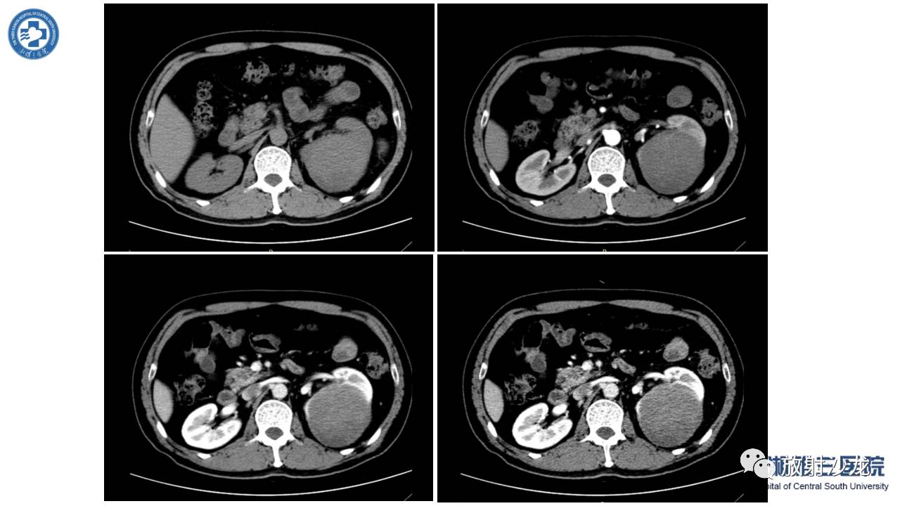 左腰侧边撞伤里面隐隐作痛,左腰被撞现在肚子痛