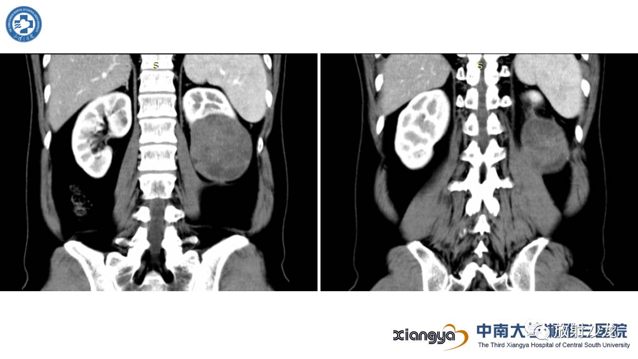 左腰侧边撞伤里面隐隐作痛,左腰被撞现在肚子痛