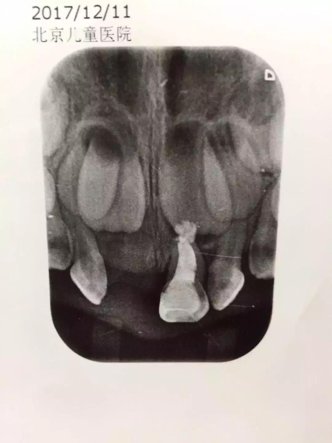带娃看牙医,带孩子看牙医拍片不给片子