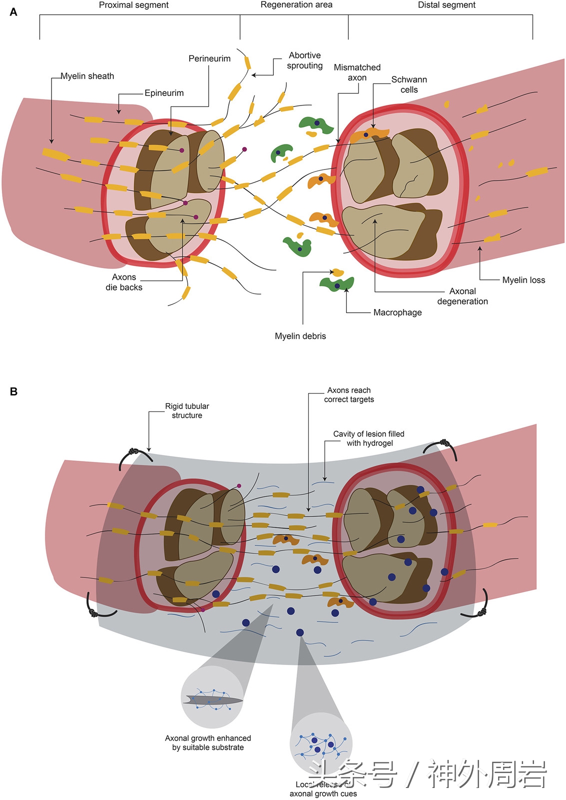 神经断裂后的再生痛苦,创伤性神经瘤症状和治疗
