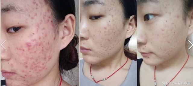 换季就长痘什么原因,一到换季就长痘怎么回事