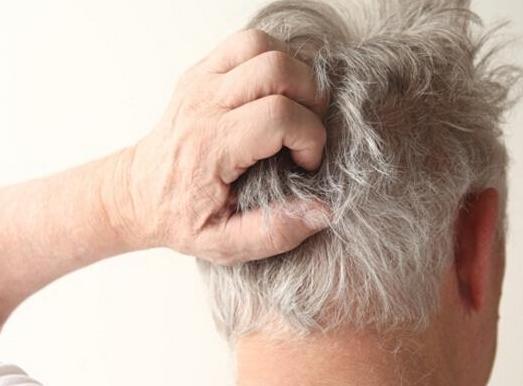 发红发痒还有皮屑是脂溢性皮炎吗,皮肤发红痒脂溢性皮炎