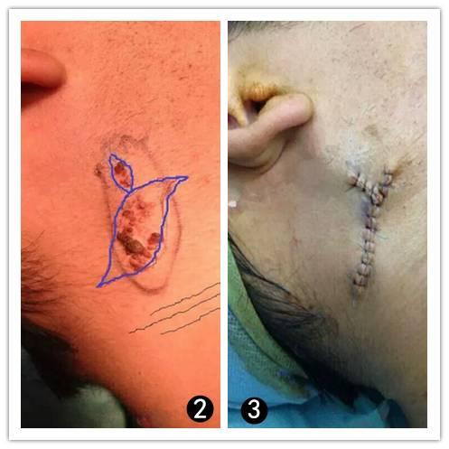 痣上长小疙瘩是什么原因,痣小比较深怎么办