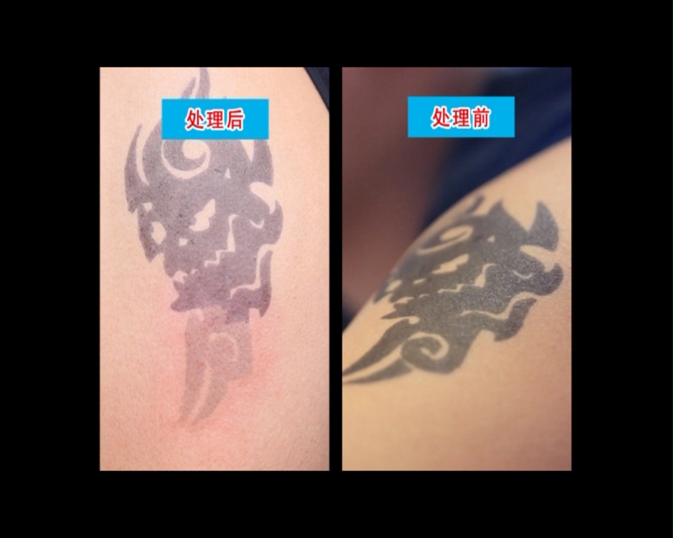 去除纹身激光得花多少钱,激光去除纹身的原理