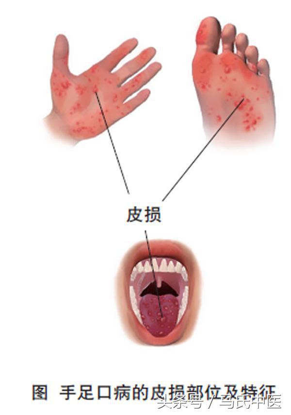 手足口病中医解决方法,手足口病中医怎么治疗