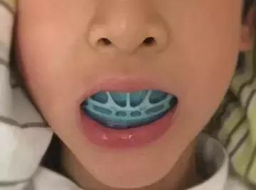 纠正张嘴呼吸会变丑的方法,张嘴睡觉鼻子呼吸会变丑吗