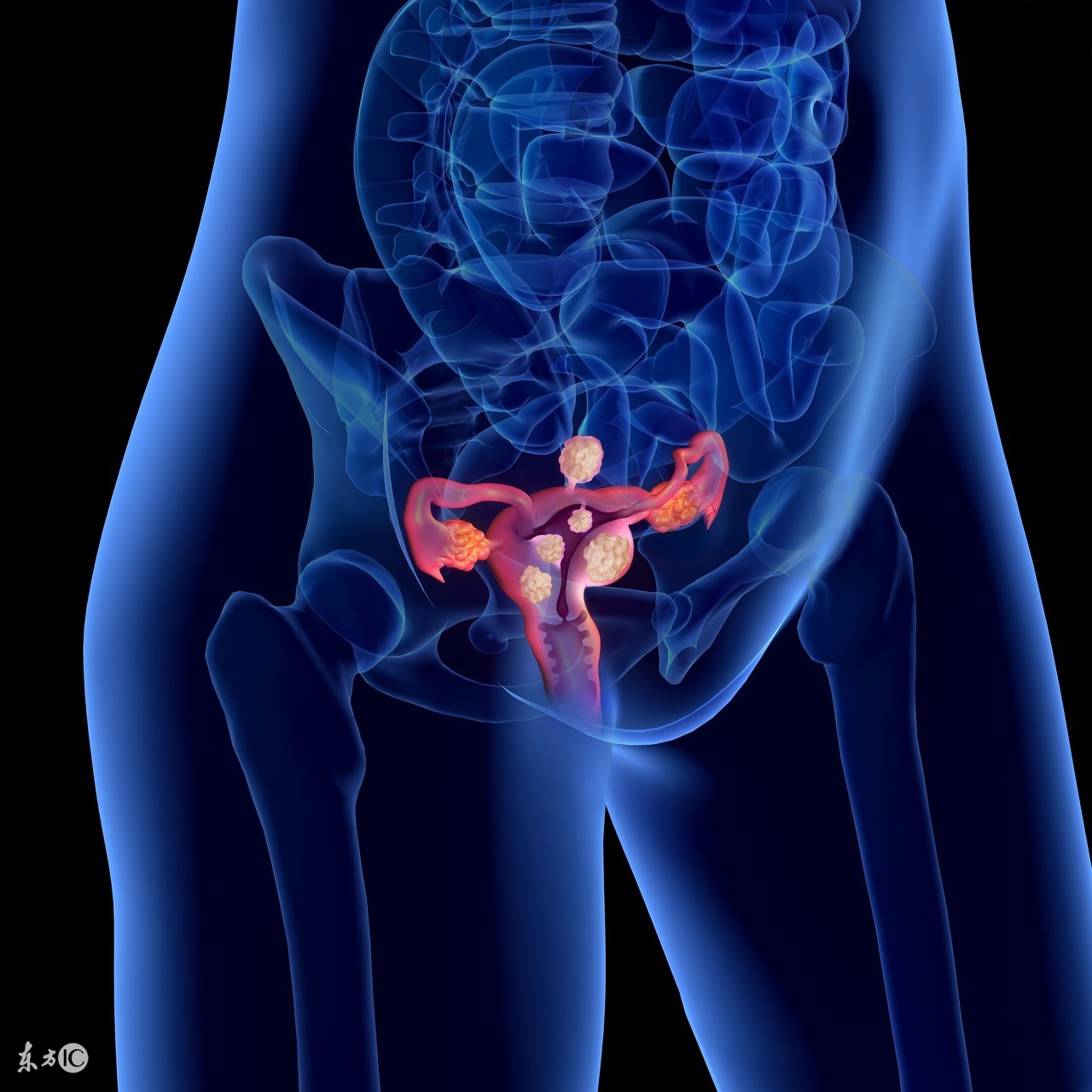 子宫内膜增厚刮宫后注意事项,内膜增厚宫腔镜刮宫后注意事项