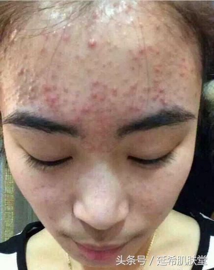 鐥樼棙鏆楃柈鍙互鐢ㄦ殫鐤拡鎸ゅ悧,鏆楃柈閽堟不鏆楃柈