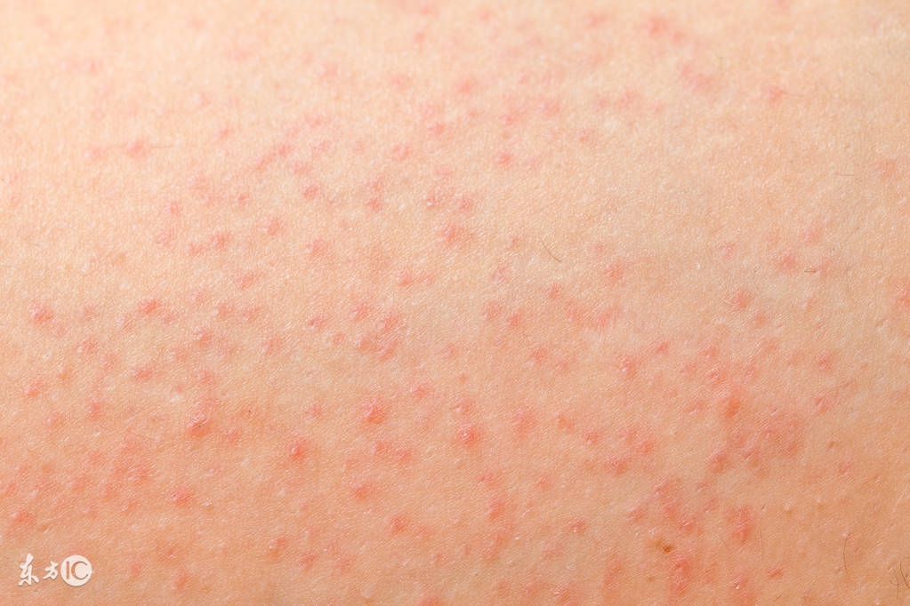 毛囊炎患者护理措施是怎样的呢