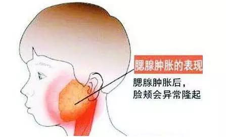 儿童腮腺炎需要请假多久,小孩腮腺炎怎么跟老师请假