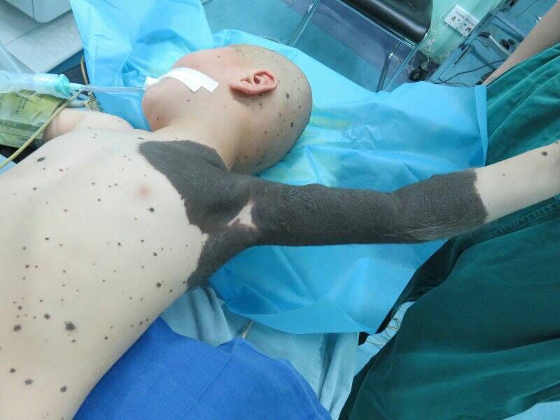 兽皮痣和巨大性黑痣图片,巨大兽皮痣癌变风险