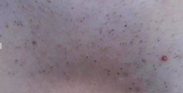 怎样分辨酒渣鼻,酒渣鼻严重怎么治疗