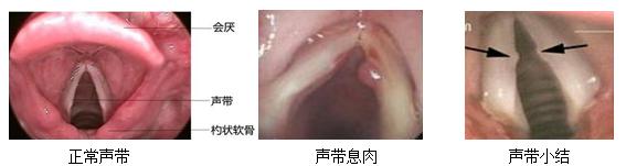 突然间声音变哑是什么原因呢,声音变沙哑了要做什么检查
