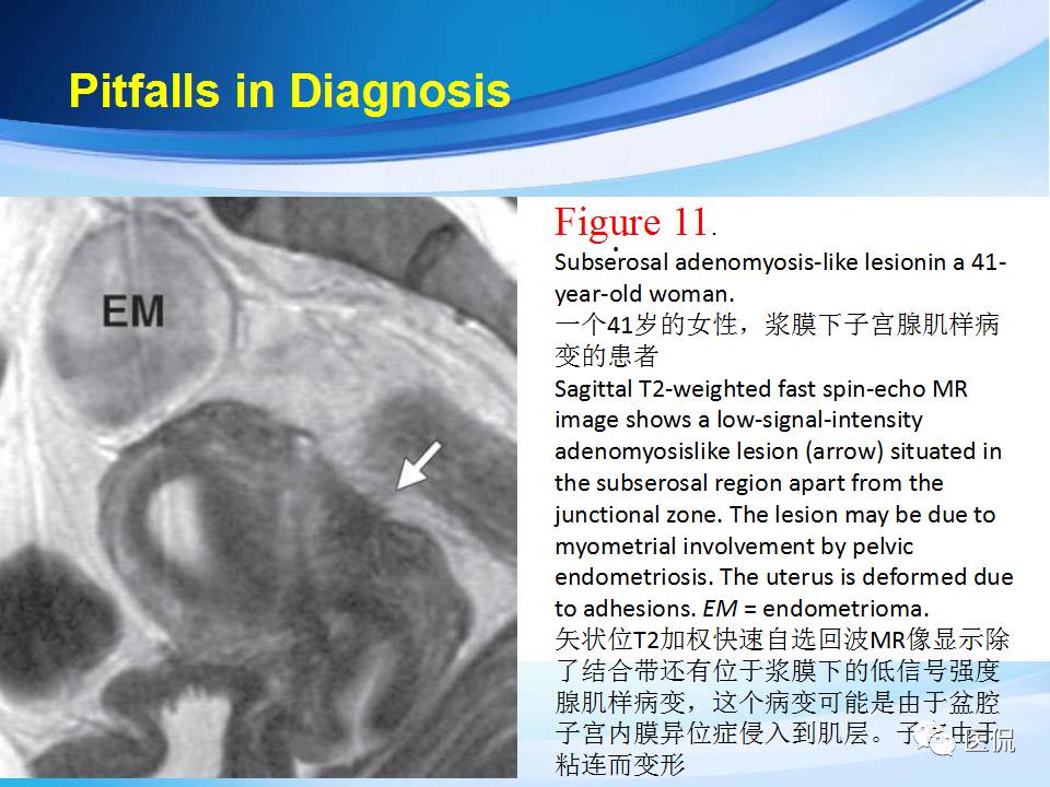 双语PPT：子宫腺肌症常见和不常见的MRI表现医学影像
