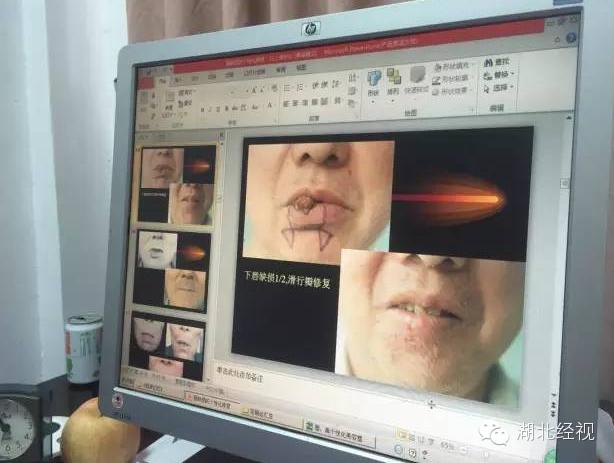 嘴唇长小肿块一查竟是癌！这个保护措施，不只女人需要！