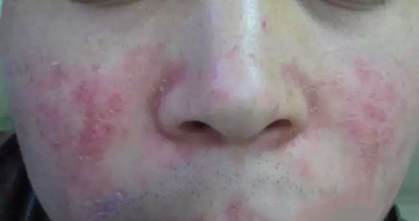 酒渣鼻怎么改善学生党,酒渣鼻严重怎么彻底治疗