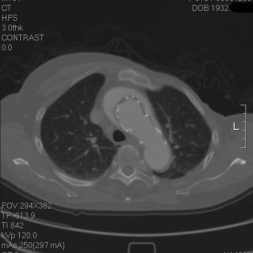 主动脉夹层袭来的恐慌,你不懂