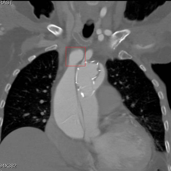 主动脉夹层袭来的恐慌,你不懂