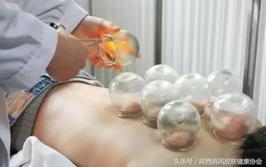 银屑病皮肤病患者,皮肤病银屑病患者