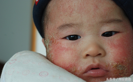 治疗湿疹非激素类药膏,婴儿湿疹激素类药膏怎么用