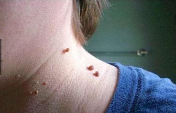 脖子上长了很多小颗粒怎么调理,脖子会出现各种症状及原因