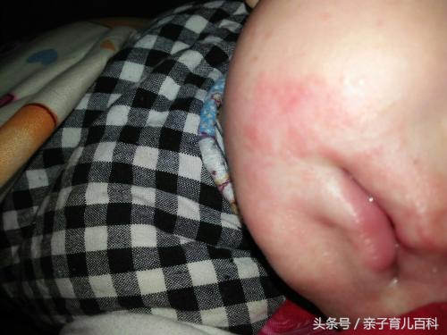 十岁湿疹反反复复不好,儿童嘴角湿疹反反复复