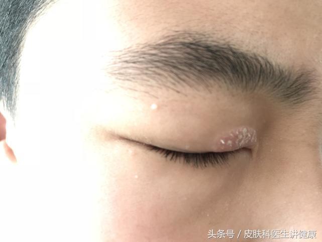 胳膊上长了皮疹是不是神经性皮炎,眼睛周围过敏性皮疹