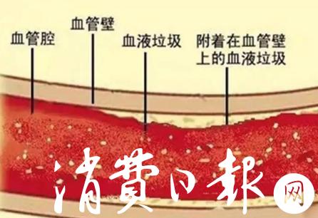 血氧疗法最新视频,蓝氧疗法有什么危害