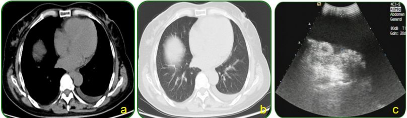 同为腹水，命运迥异