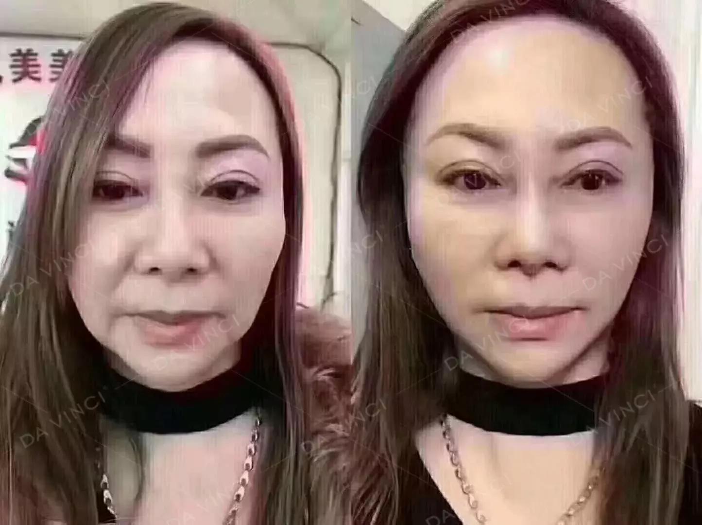 线雕提升的效果图,线雕青春定格术多久消肿